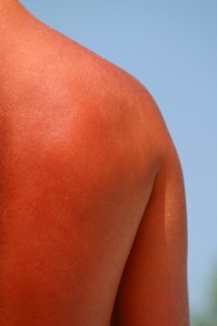 sunburned skin