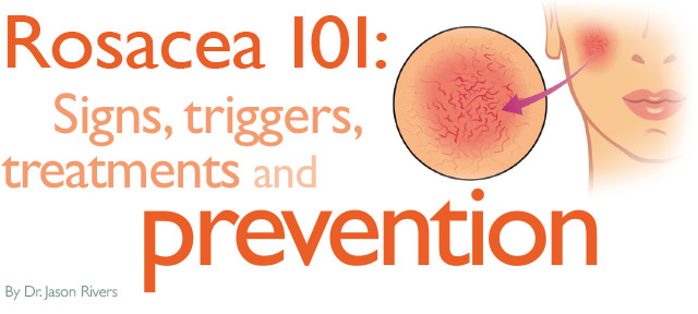 Rosacea 101: Signs, triggers, treatments and prevention