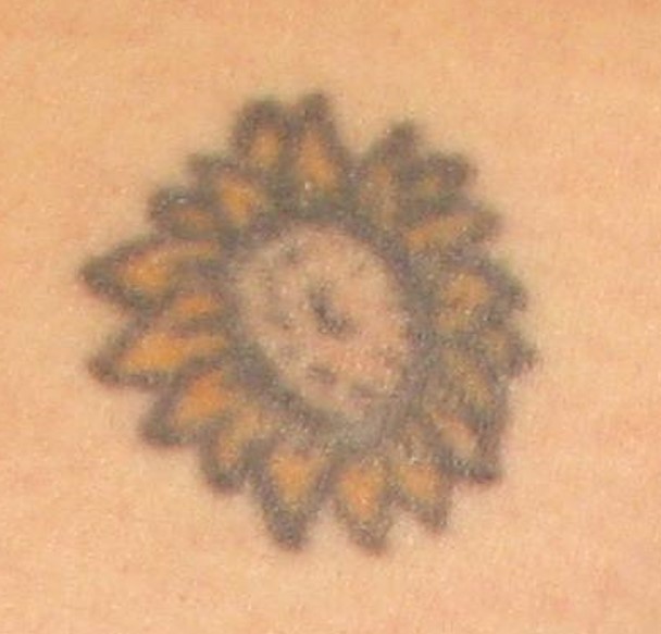 Laser Tattoo Removal | Painless Tattoo Removal | Vancouver