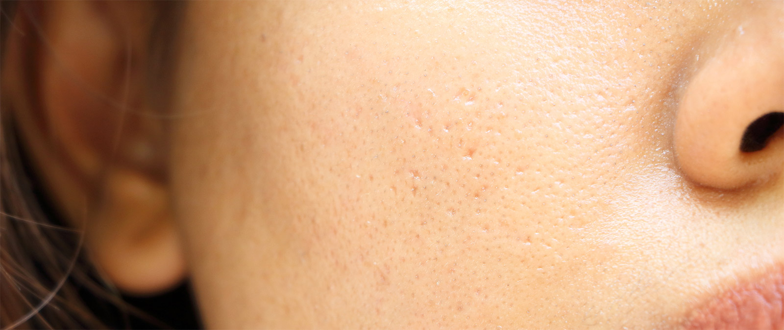 Enlarged Pores Skin Conditions Pacific Derm
