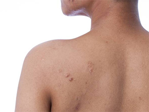 back acne