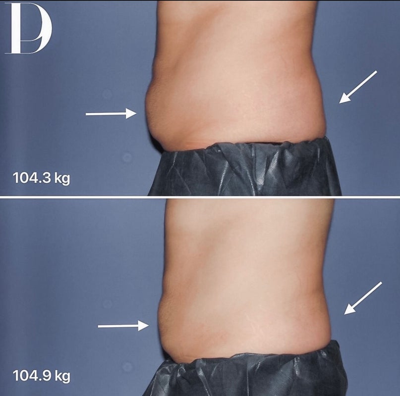 How Long Do Body Contouring Results Last? Pacific Derm Answers