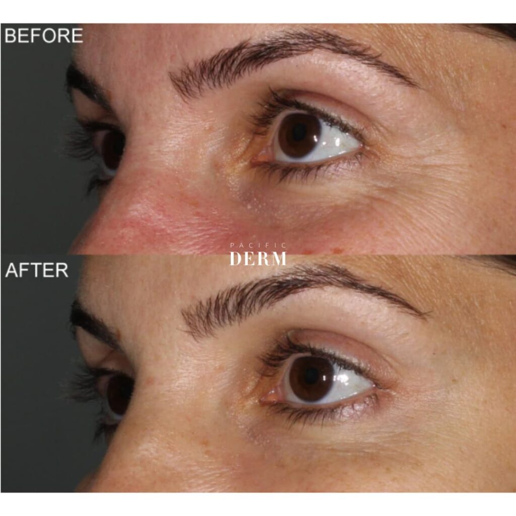 before and after - botox crow's feet