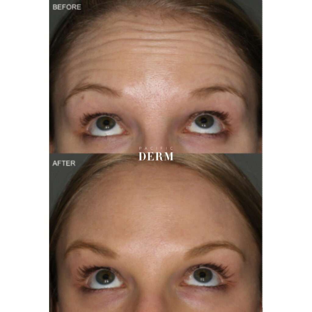before and after - botox forehead