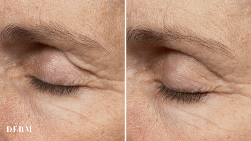 thermage before and after - eyes