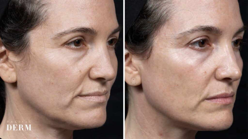 thermage before and after - face