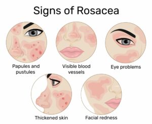 Signs of rosacea